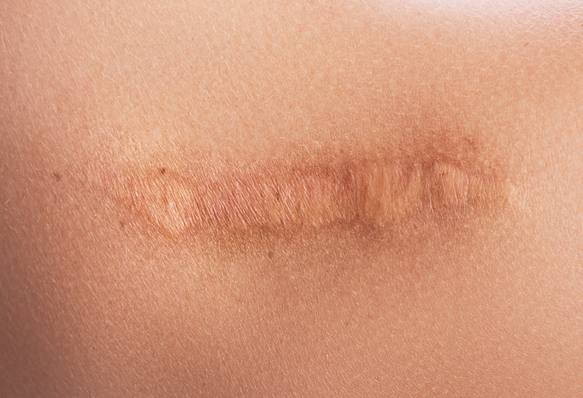 Surgery scar