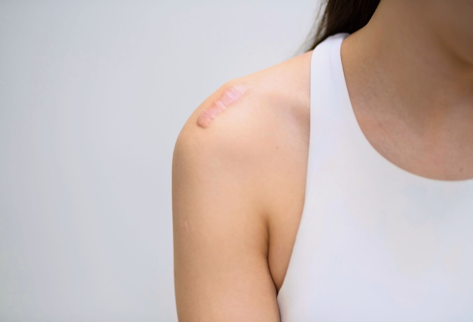 How to prepare for shoulder surgery: Close-up of a shoulder with a visible post-surgery scar, showing healed skin on a person wearing a white tank top.