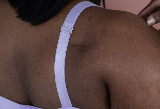 shoulder surgery bra: a close up of a woman with a shoulder surgery scar wearing a Springrose shoulder surgery bra